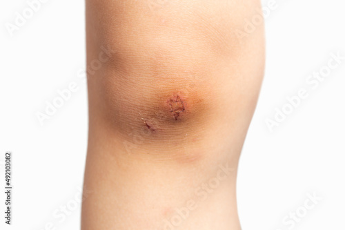 Closeup of unrecognizable boy with injured knee isolated on white