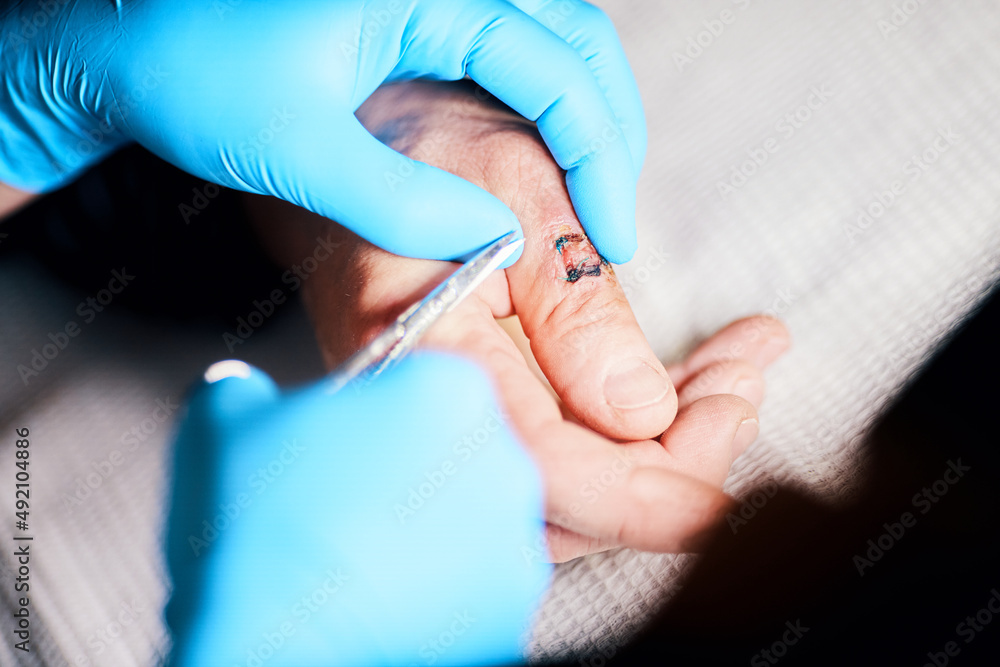 removal of sutures on the finger wound manually medical care removal of sutures on the finger wound manually medical care