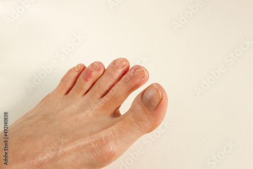 Middle-aged woman toes with chilblains photo