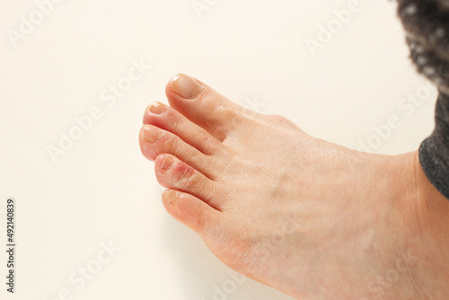 Middle-aged woman toes with chilblains photo