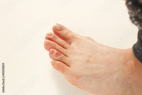 Middle-aged Japanese woman toes with chilblains