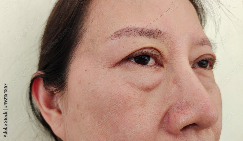 close up the flabbiness adipose hanging skin under the eyes, problem wrinkled skin on the face of the woman, concept health care.