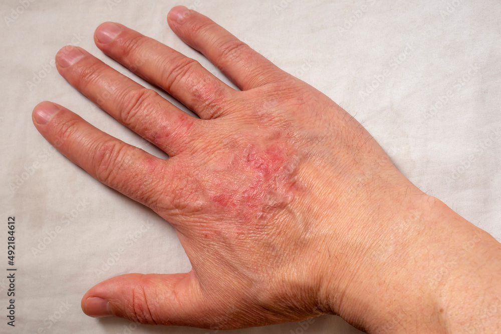 Fototapeta premium Healing burns on the arm. Scars on the arm after a thermal burn.