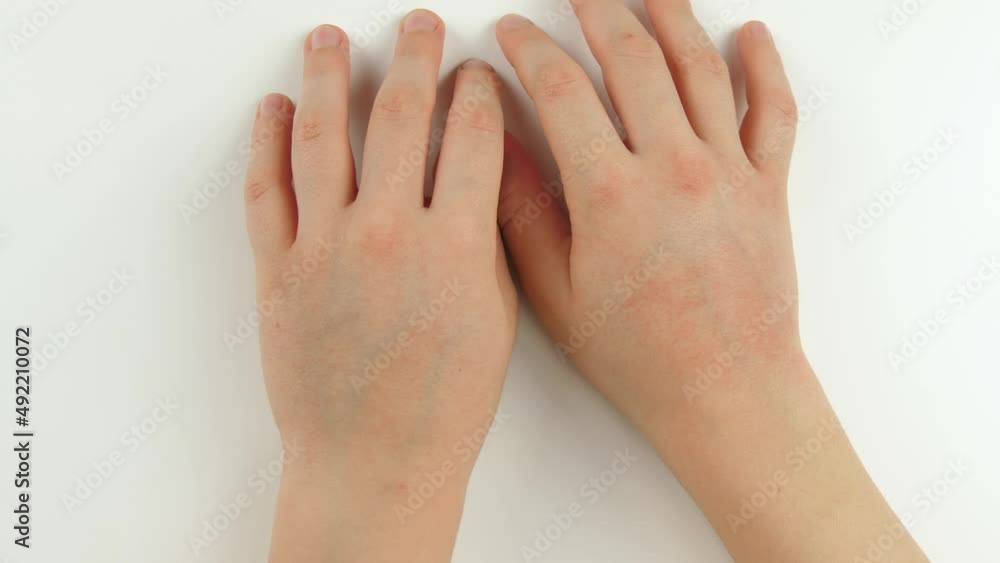 Kid hands close-up. Allergies, dermatitis on the skin. Children's health. Irritation on the skin. Baby Skin care Kid hands close-up. Allergies, dermatitis on the skin. Children's health. Irritation on the skin. Baby Skin care