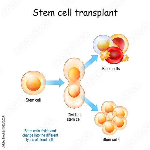 Stem cell transplant