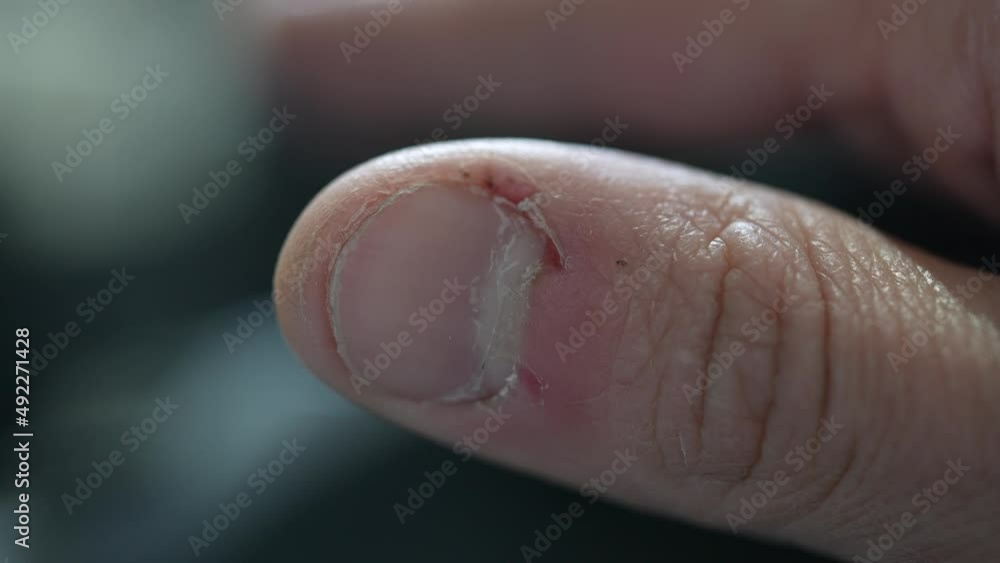 bitting nails finger. anxiety, worry and nervous concept. bad habit bitting nails finger. anxiety, worry and nervous concept. bad habit