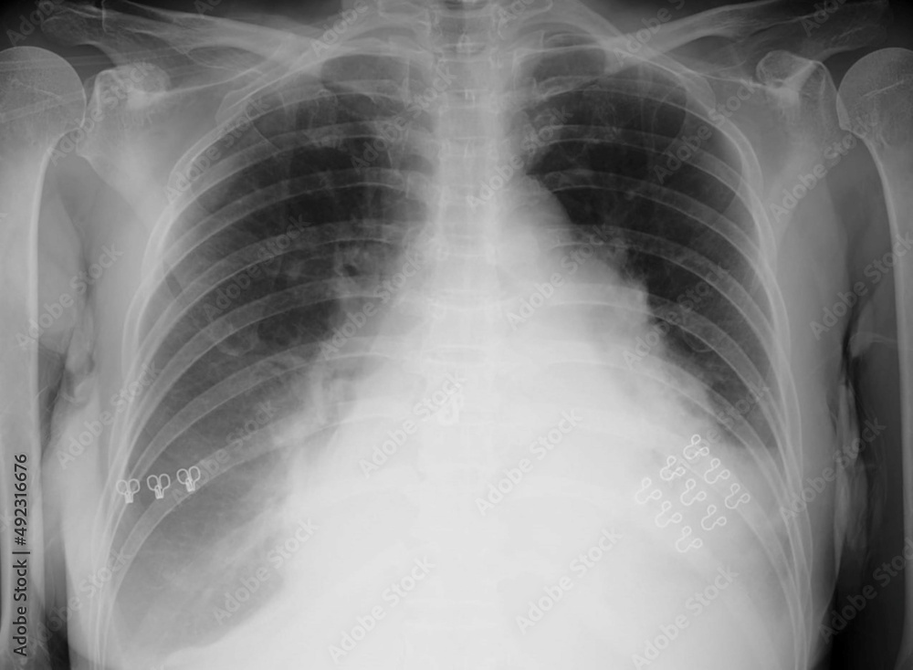 Cardiomegaly Chest X Ray