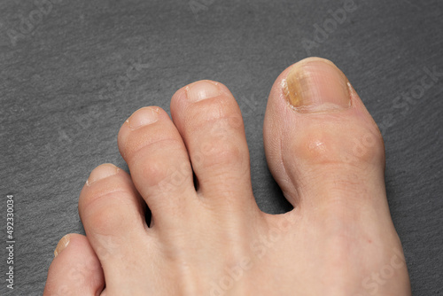 Toenails with fungus problems,Onychomycosis, also known as tinea unguium, is a fungal infection of the nail, gray table. photo