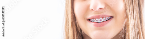 Dental brace on healthy teeth of a young teenage girl.