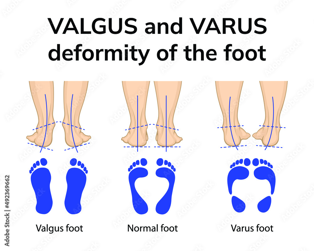 Vetor De Illustration Of The Position Of The Feet In Varus And Valgus