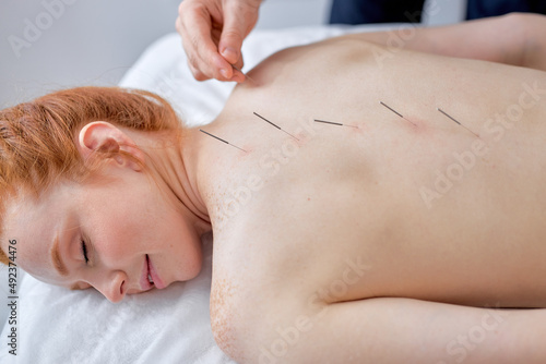 Acupuncturist treats female patient's illness with acupuncture at special points on back spine. Acupuncture is alternative medicine, healthy treatment concept. close-up focus on spine,body