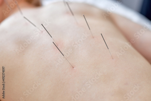 acupuncture therapy on spine, shoulders for woman client. female undergoing acupuncture treatment with fine needles inserted into slim body skin in clinic hospital, lying on couch, close-up photo