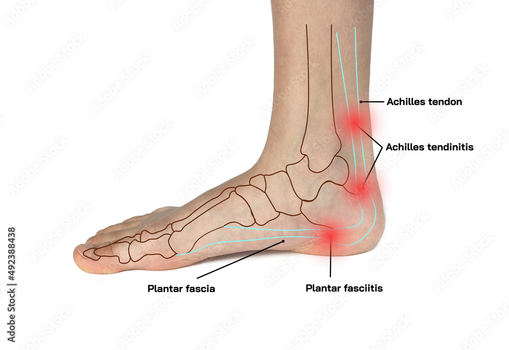 Bruised heel remedies and when to see a doctor