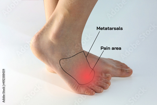Konstfotografi Close up foot isolated on white background with red area explain to Morton's neuroma pinched nerve, the pain in between the toes in metatarsal bones while walking