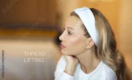 Thread Lift ,markup, thread-lift procedure for facial rejuvenation. photo