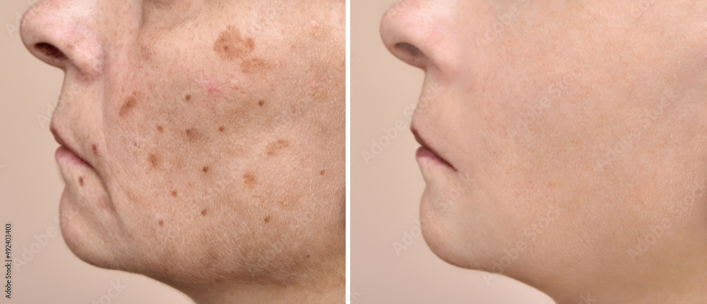 Woman Before And After Melasma And Brown Spots Treatment On Her Face