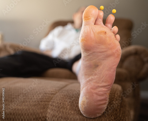 Image of older male's foot post hammertoe surgery with pins extending out of the second and third toe. The photo shows dry skin around the foot after being covered for six weeks. photo