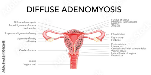 Diffuse Adenomyosis with inscriptions, Human anatomy Female reproductive Sick system organs. Structure of uterus, cervix, ovary, fallopian tube in Latin text. Frontal view in a cut Vector illustration