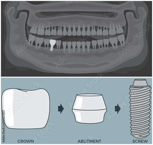 Black and white x-ray of human jaw with normal teeth and prosthesis above structure of dental implant. Tooth after medical procedure, dental treatment. Oral implantation. Radiograph with prosthesis