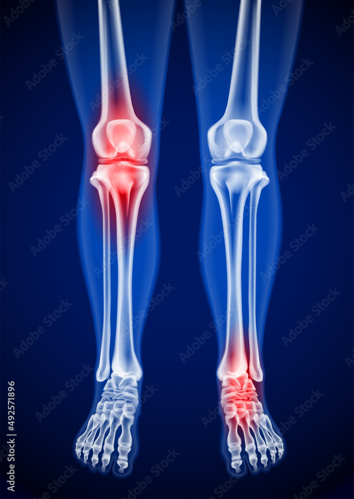 Human femur, knee and foot x-rays showing pain points in red for ...