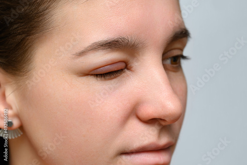 A closeup view on the eyes of a caucasian girl, with one eye close, painful, red and swollen from a hordeolum (stye), common bacteria infection of the eye.