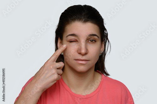 Portrait of woman with chalazion (hordeolum) on upper eyelid. Staphylococcus viral infection. The girl points her finger at the big eye. photo
