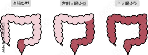 潰瘍性大腸炎のイラスト