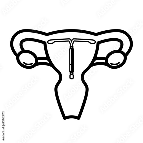 Women's contraception: IUD in 
uterus. Vector illustration 