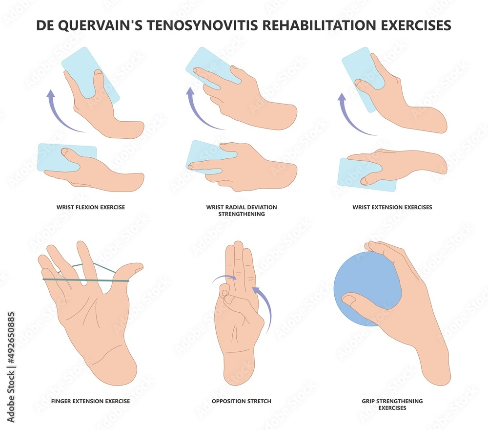 De Quervain S Tenosynovitis Physio Exercises RDVXT De Quervain S Tenosynovitis Physio Exercises RDVXT