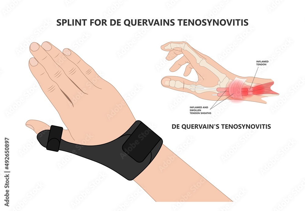 Vetor de De quervain's pain tendon thumb wrist hurt grasp make a fist