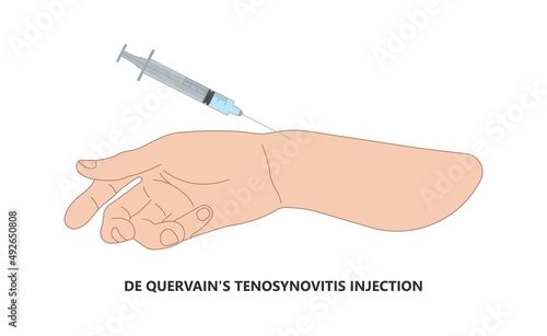 De quervain's pain tendon thumb wrist hurt grasp make a fist sport muscle hand Finkelstein's test bend brace finger strain trigger carpal tunnel brevis Eichhoff's stretch radial Grip spring relief