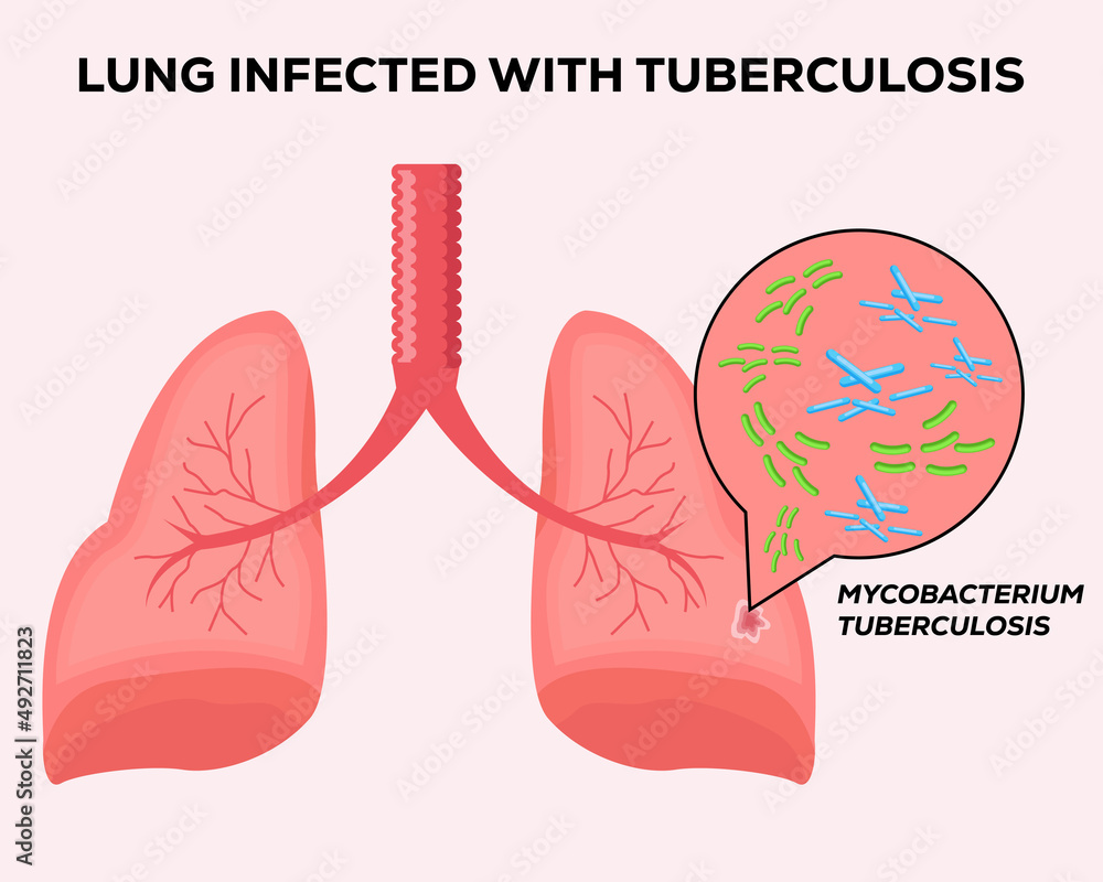 Obraz premium human lungs infected with tuberculosis
