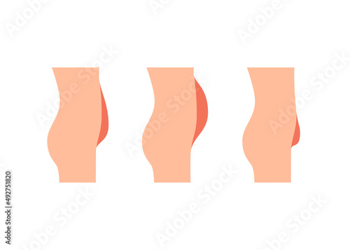 Types bellies of human body, big belly with overweight, excess weight. Sagging, protruding and superficial tummy. Loss weight, reduce volume belly, surgery plastic operation. Vector illustration