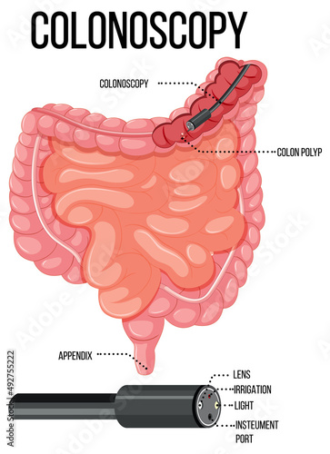 Diagram showing colonoscopy in human