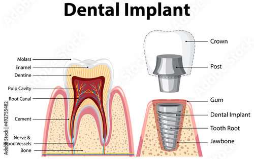 Infographic of human in structure of the dental implant