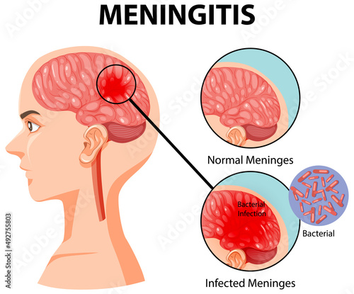 Diagram showing meningitis in human brain photo