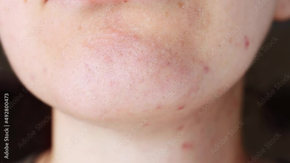 Sick female facial skin with pimples, acne and black dots close-up. Sick female facial skin with pimples, acne and black dots close-up.
