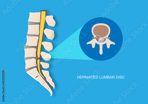 Vector illustration of back pain caused by herniated lumbar vertebral disc. Intervertebral disc protrusion causing nerve root compression.