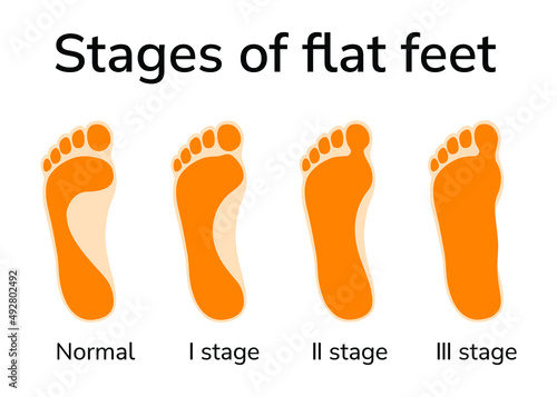 Illustration of three stages of flat feet. Four footprints depicted - normal position and stages of deformity 