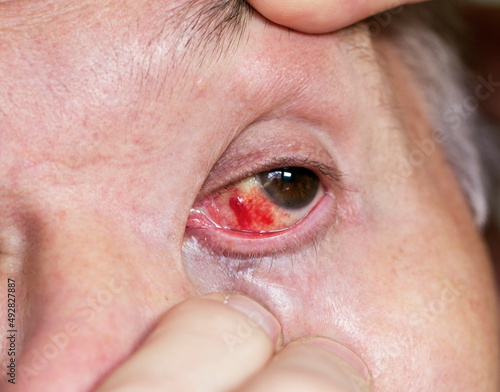 Red eye, cracked capillaries, inflammation, large eye