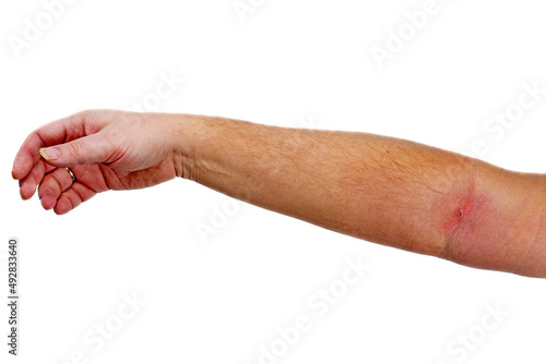 Phlebitis on hand isolated on a white photo
