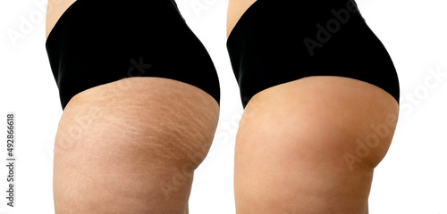 Image compare before and after Woman legs and buttocks with stretch marks removal treatment isolated on white background. photo