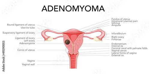 Adenomyoma Adenomyosis with inscriptions, Human anatomy Female reproductive Sick system organs. Structure of uterus, cervix, ovary, fallopian tube in Latin text. Frontal view Vector illustration