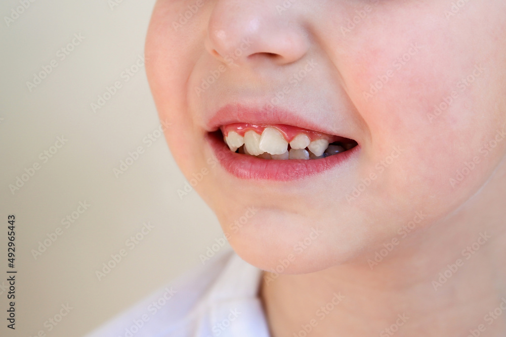Child has crooked teeth. The concept of crowding of molars. Stock Photo ...