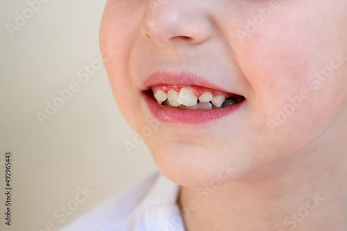 Child has crooked teeth. The concept of crowding of molars.