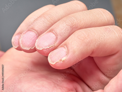 Hand of a child with weak or brittle fingernails  isolated on gray background  no faces are shown   close up look