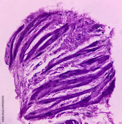 Prostate histology(TURP): Photomicrograph of biopsy of prostate gland showing fibromuscular tissue. no malignant cells present. photo