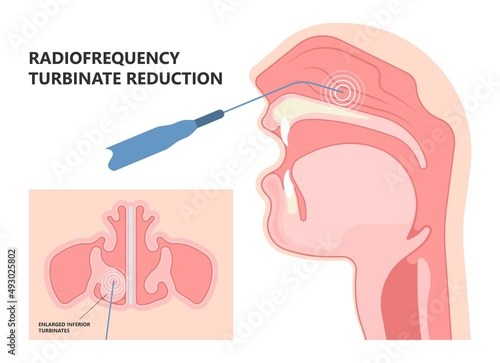 Deviated Ear ENT CPAP nose stop apnea block laser nasal RAVOR RFVTR runny sinus sleep treat airway concha device mucous polyps septal septum throat tissue airflow air way bullosa drip allergic