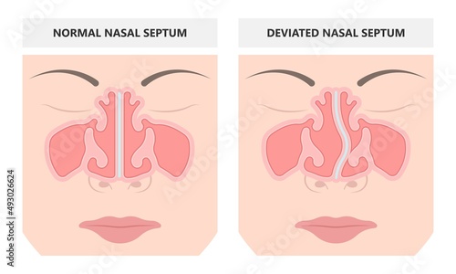 Deviated Ear ENT CPAP nose stop apnea block laser nasal RAVOR RFVTR runny sinus sleep treat airway concha device mucous polyps septal septum throat tissue airflow air way bullosa drip allergic
