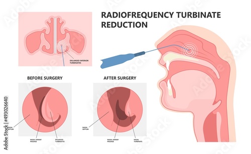 Deviated Ear ENT CPAP nose stop apnea block laser nasal RAVOR RFVTR runny sinus sleep treat airway concha device mucous polyps septal septum throat tissue airflow air way bullosa drip allergic